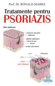 tratament pt pso